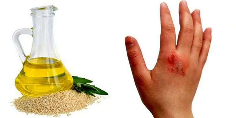 روغن ارده کنجد برای سوختگی
